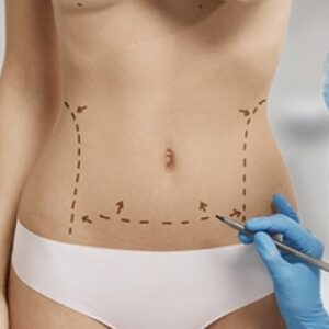 LIPO DOS FRANCOS COM BODYTITE
