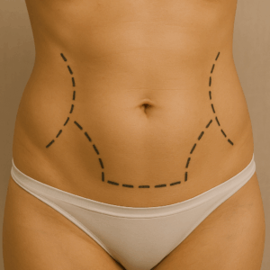 LIPO ABDOMEN + BODYTITE E MORPHEUS