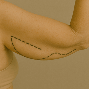BRAQUIOPLASTIA