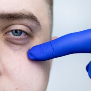 BLEFAROPLASTIA INFERIOR