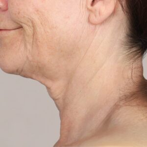 DEEP NECK + DEEP PLANE