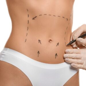 ABDOMINOPLASTIA