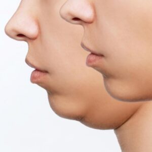 LIPO FILLER FRONTE E MENTO