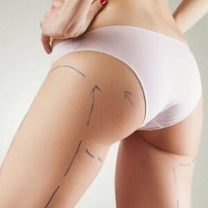 CRUROPLASTIA + ARGOPLASMA + BODYTITE + MORPHEUS NAS PERNAS E CULOTES