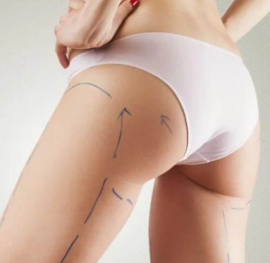 CRUROPLASTIA + ARGOPLASMA + BODYTITE + MORPHEUS NAS PERNAS E CULOTES