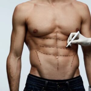 LIPO HD (ABDOMEN)