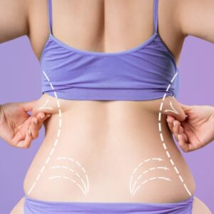 ABDOMINOPLASTIA REVERSO