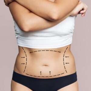 ABDOMINOPLASTIA + LIPOESCULTURA