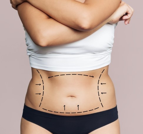 ABDOMINOPLASTIA + LIPOESCULTURA