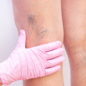 Vascular Estética