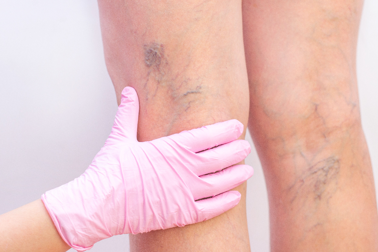 Vascular Estética